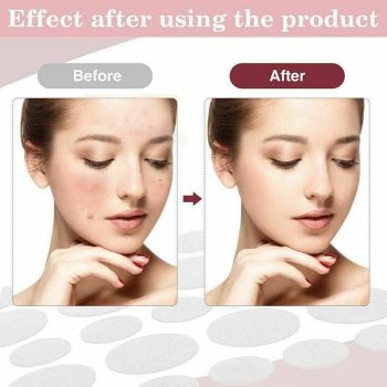 36 Pcs Acne Pimple Plasters Patch Removal Blemish Control Skin Facial Care Spot