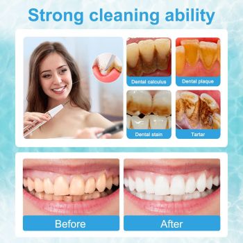 Ultrasonic Dental Scaler Kit - Home Use Teeth Cleaner & Tartar Remover