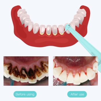 Intelligent High-Frequency Vibration Dental Calculus & Stain Remover(pink)